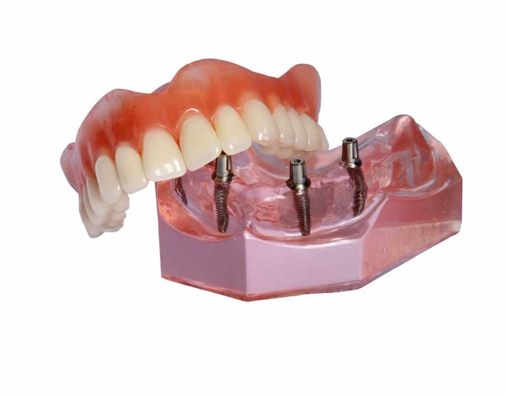 Snap on veneers vs. fixed dentures Which is best and why 31410 1 - Snap-on veneers vs. fixed dentures: Which is best and why?